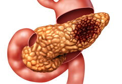 “Gestione integrata dell’adenocarcinoma del pancreas”, evento ECM